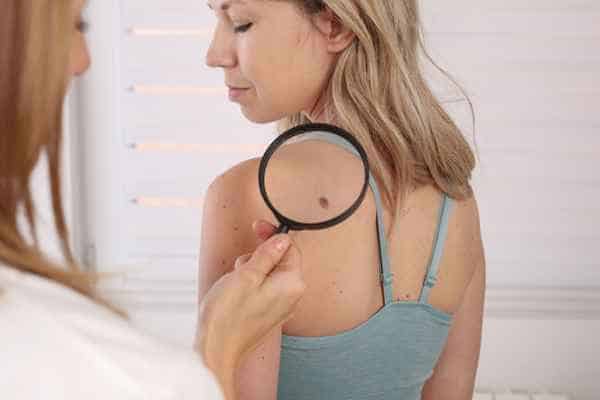 What Are Traditional Skin Lesion Removal Methods Barking and Dagenham?