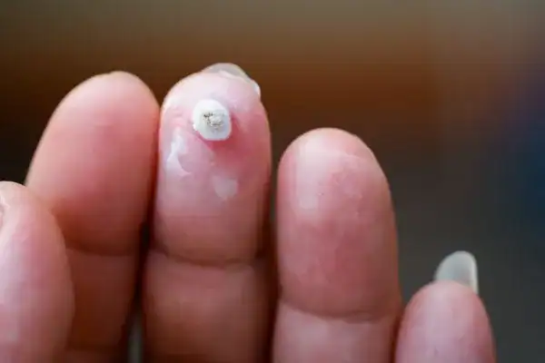 Image of white wart before cryopen treatment Barking and Dagenham