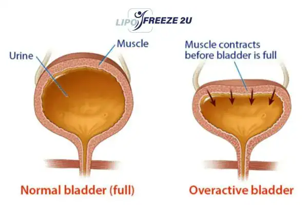 diagram of overactive bladder treatment Barking and Dagenham