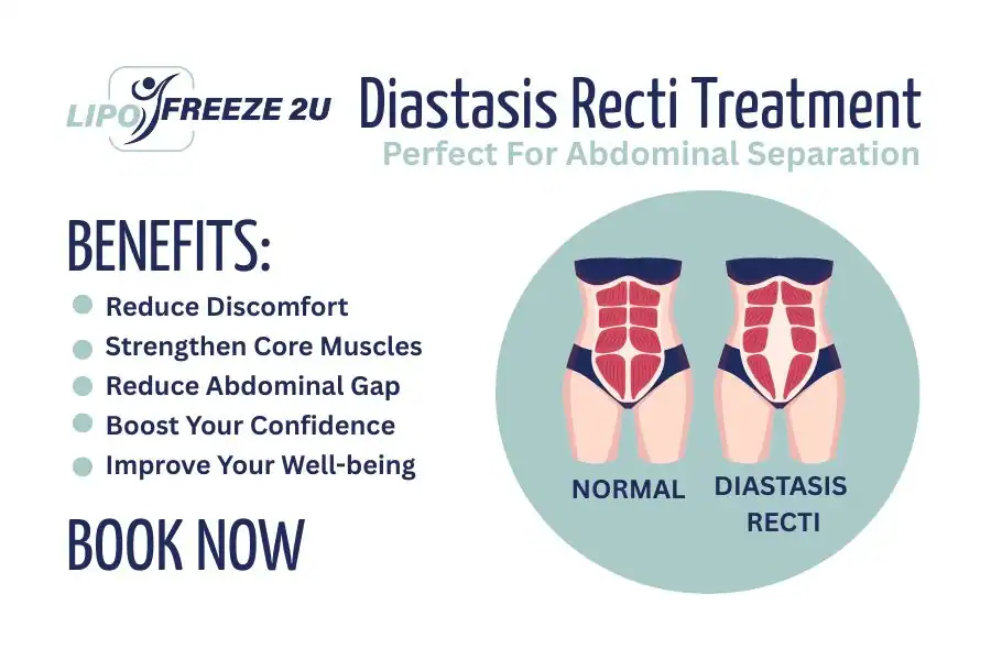 How Long Will It Take to See Improvements in Diastasis Recti Barking and Dagenham