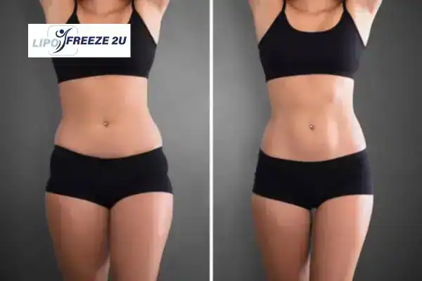 How Can LIPO FREEZE 2U Support Your Post-Pregnancy Body Recovery Barking and Dagenham?