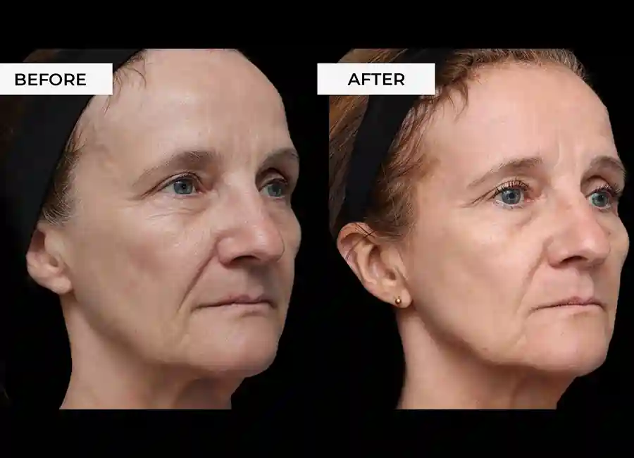 How Many RF Microneedling Sessions Will You Need to See a Difference Barking and Dagenham?