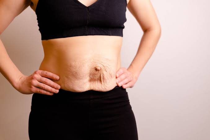 Is Surgery Really the Only Way to Repair Diastasis Recti Barking and Dagenham?