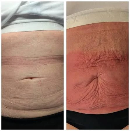 How Does RF Microneedling Improve Crepey, Thin and Uneven Skin Texture Barking and Dagenham?