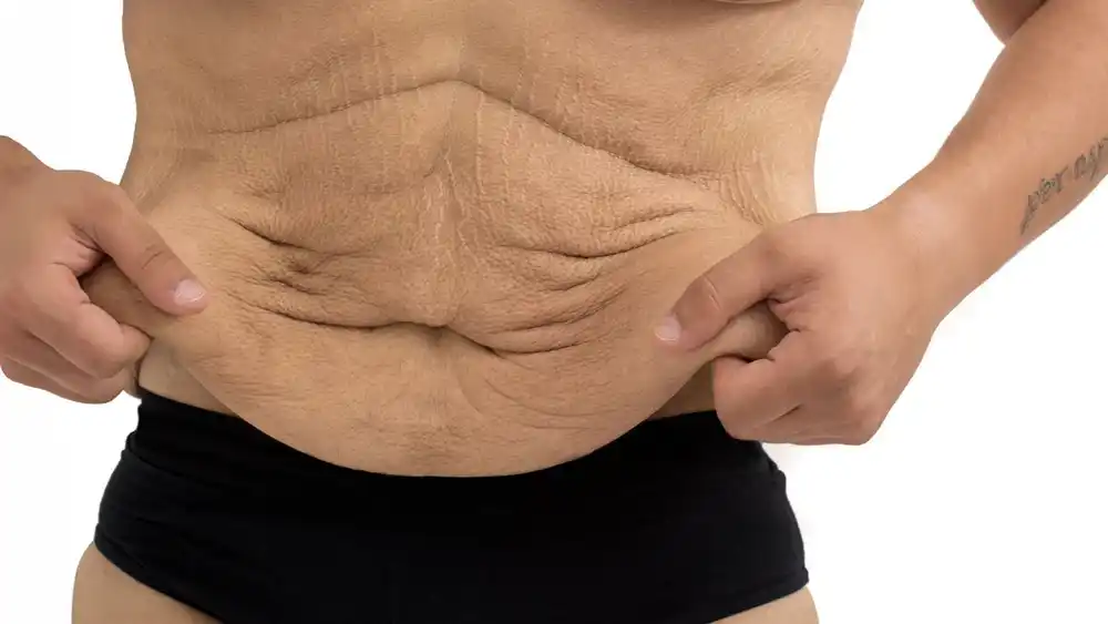 RF Microneedling for Loose Skin: How Can It Help Tighten and Reshape the Skin Barking and Dagenham?